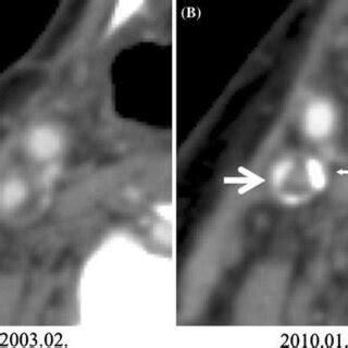 Case 2. a ICA stenosis shown by the NASCET ratio of 42 % (arrow). b ...