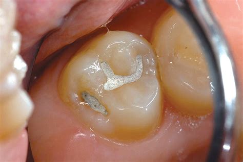 Resurfacing Resin-Modified Glass-Ionomer Restorations | January 2009 | Inside Dentistry