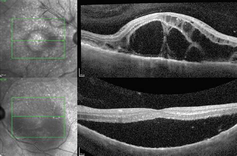 Distinguishing VKH From CSCR - Retina Today