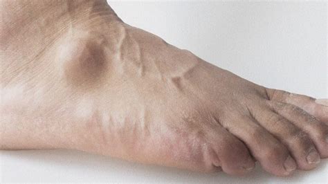 Ganglion Cyst On Top Of The Foot: What Is It? Feet First, 59% OFF