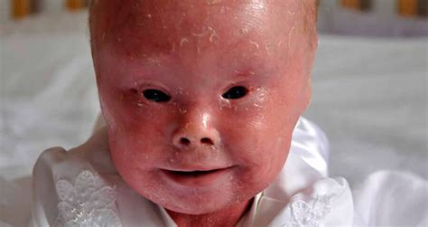 Harlequin Ichthyosis: Photos And Stories Of The Rare Skin Disease