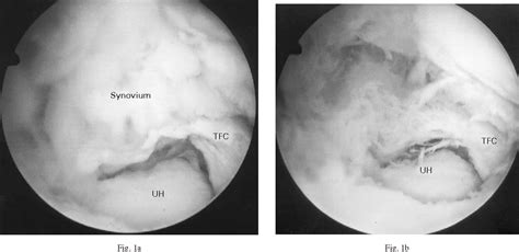 Figure 1 from Arthroscopic synovectomy of the wrist in rheumatoid ...