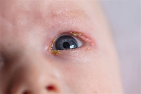 Allergic conjunctivitis in children - Allergy & Immunology Doctor