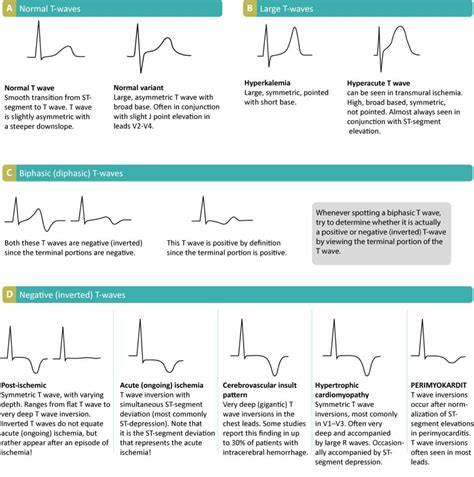 T-waves in ischemia: hyperacute, inverted (negative), Wellens sign & de ...