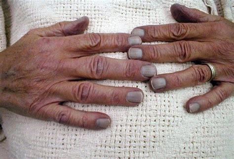 Blue fingernails - The symptom unpacked