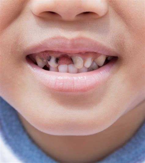 What Causes Tooth Decay In Children, Treatment & Prevention