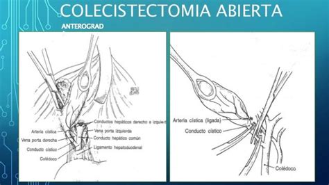 Colecistectomia Abierta y Laparoscopica