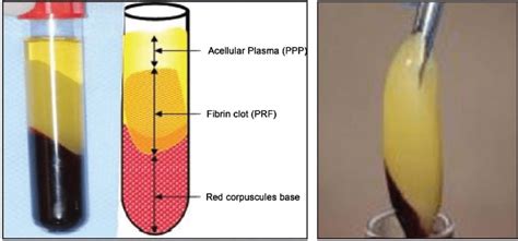 Left: Blood on the vacutainer tubes after centrifugation, divided into... | Download Scientific ...