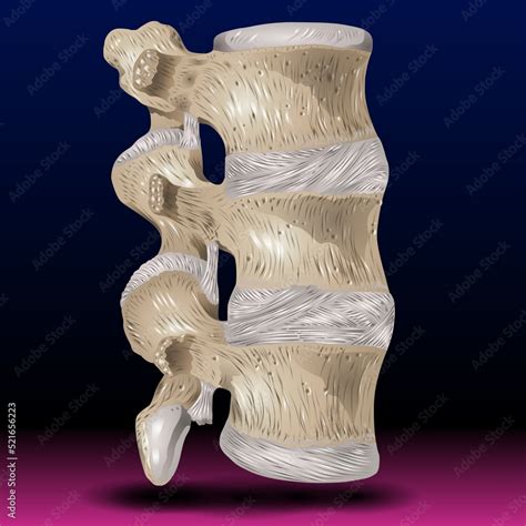 Spondylitis - Fla source file available - Ankylosing Spondylitis Realistic Vector Medical Chart ...