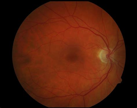 Moran CORE | Bilateral Bull’s Eye Maculopathy