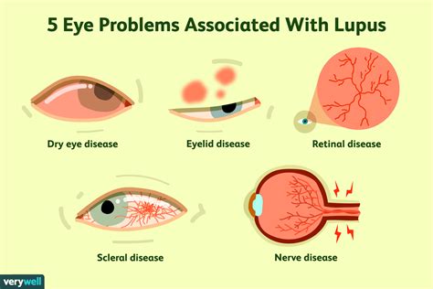 Purple Eyes Disease
