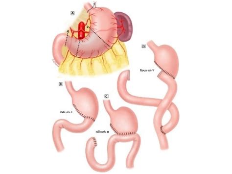 Morbidly obese after a Billroth II procedure