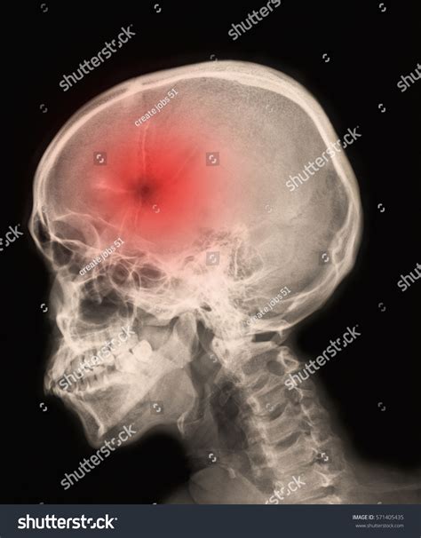 Mri Scan Brain Showing Result Brain Stock Photo 571405435 | Shutterstock