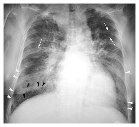 Lobar Consolidation and Collapse (CXR) Flashcards | Quizlet