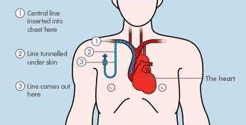 Hickman Catheter Removal