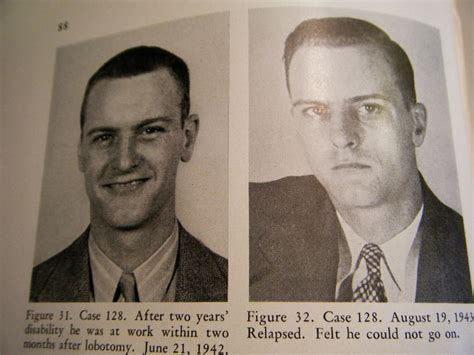 Do You Need a Lobotomy? Just Look at the Results From These Before and After Photo Comparisons ...