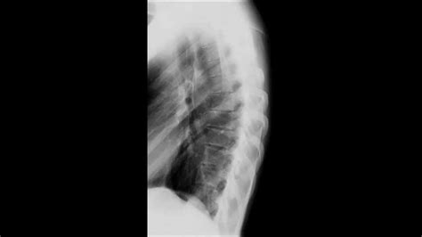 Lateral Thoracic Spine X Ray Positioning