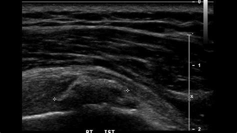 Tendon and Ligament Ultrasound - Internet Book Of MSK Ultrasound