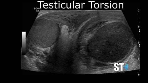 Testicular Doppler Ultrasound