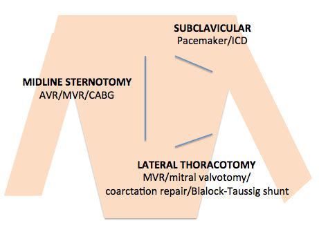 Types of cardiothoracic surgery - pasaarctic