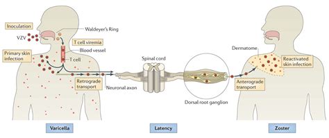 Varicella Zoster Virus- An Overview