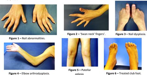 Figure 1 from Total Knee Replacement in Nail Patella Syndrome | Semantic Scholar