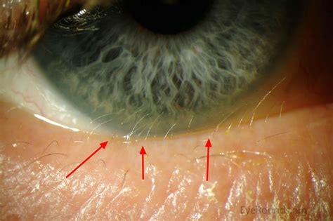 Distichiasis & Lymphedema-Distichiasis syndrome causes, symptoms ...