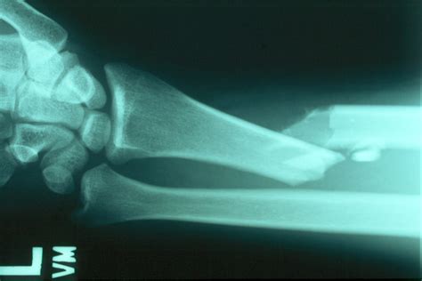 Reconstruction: Ulnar shortening osteotomy for Galeazzi fracture malunion