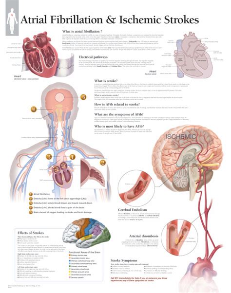 Atrial Fibrillation and Ischemic Strokes | Scientific Publishing