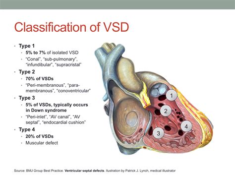 Surgical Repair of Atrioventricular Septal Defect – Dimas Yusuf