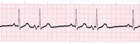 Atrial Rhythms ECG Interpretation