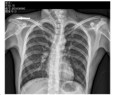 X-ray showing erosions at the acromion process of scapula | Download ...