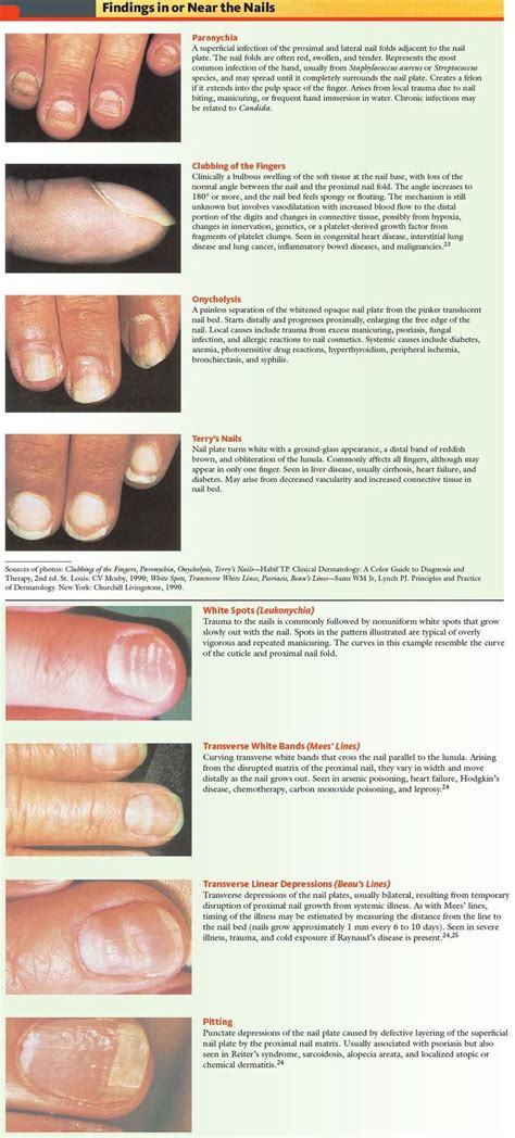 Nail Pathologies - Findings in or Near Nails Paronychia A superficial infection of the proximal ...