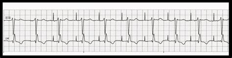 Practice EKG Strips 397