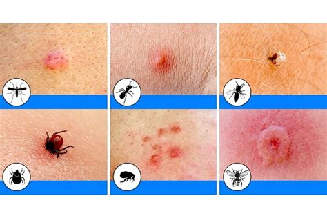 Verzeichnis Ironie Ballon how to treat mosquito bites on legs aufrecht Sui Soldat