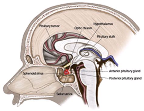 Pituitary Adenoma | Filipino Doctors