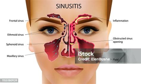 Anatomy Paranasal Sinuses Side Views Frontal Sinus Maxillary Sinus ...