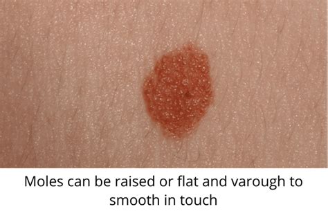 Skin Moles to Worry About – A Complete Guide With Skin Moles Pictures