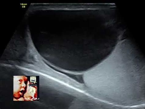 large spermatocele ultrasound by Dr.Haissam Aref, DMS, MSc, MD ultrasound - YouTube