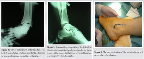 Lateral Ankle Instability after Rotational Injury: A Case Report ...