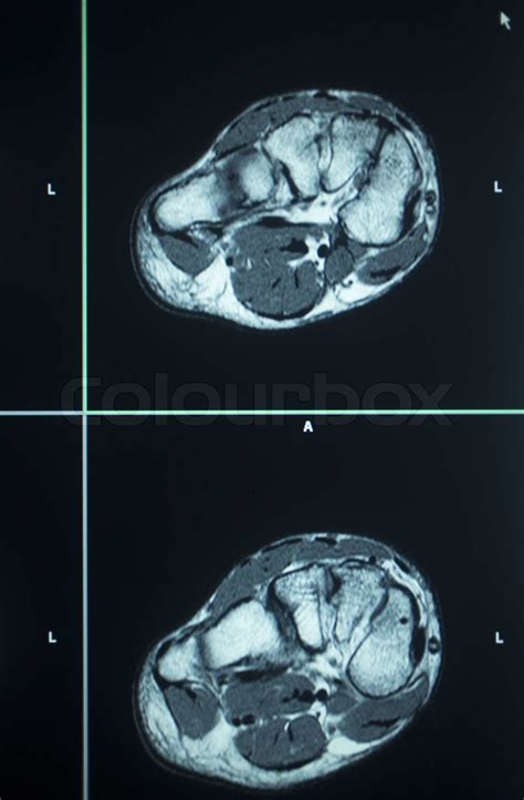 MRI scan test results foot toes injury | Stock image | Colourbox