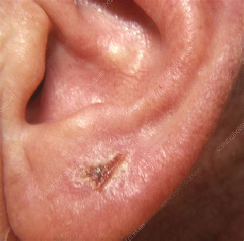 Ecthyma on Earlobe - Stock Image - C022/2120 - Science Photo Library