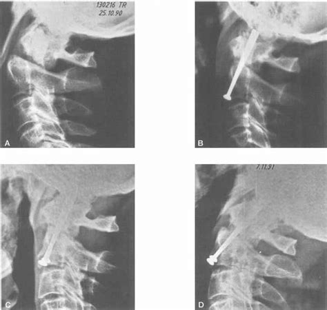 Patient 14. Type 2 fracture with the dens displaced posteriorly (A ...