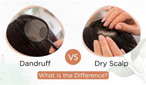 Dandruff Vs Dry Scalp: What Is the Difference? - The Indie Earth