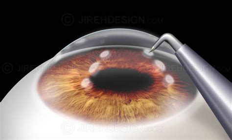 Conductive keratoplasty - #SURCK0001 | Stock eye images