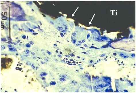 Multinucleated giant cells (arrows) on titanium plasma sprayed (TPS)... | Download Scientific ...