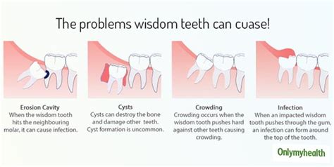 No More Bearing Wisdom Tooth Pain, Try These Excellent Remedies ...