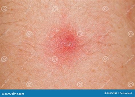 Red pimple on human skin stock image. Image of health - 88934289