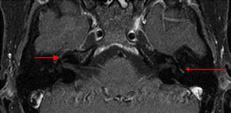 Normal and pathological findings for the facial nerve on magnetic resonance imaging - Clinical ...