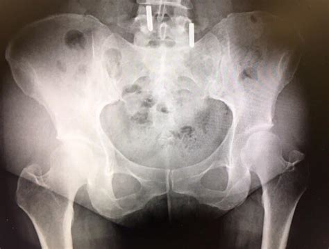 [Pre-op] Right hip dysplasia. Note the significantly smaller lateral center edge angle (abnormal ...